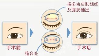 眼部整形:三种双眼皮手术图解,韩式双眼皮-868
