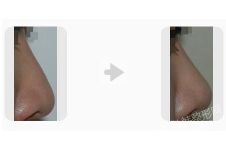 鼻部整形手术前后对比照