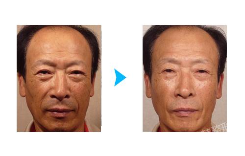 面部抗老化细胞治疗对比照