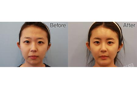 面部脂肪填充手术前后对比照