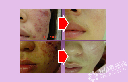 PRP自体血皮肤再生术祛痘疤前后对比照
