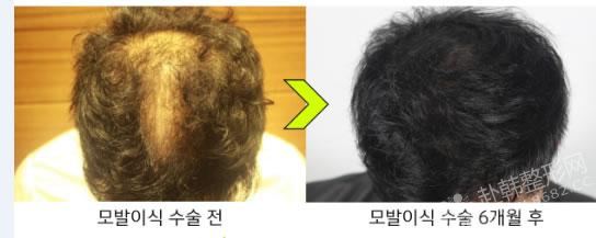 毛发移植对比照