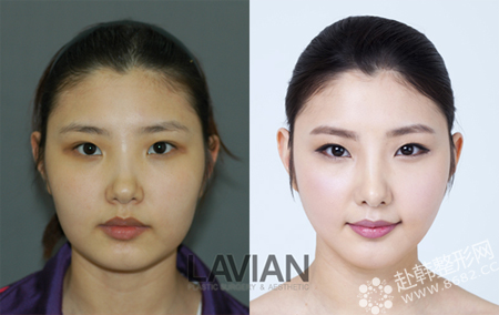 韩式瘦脸法对比照