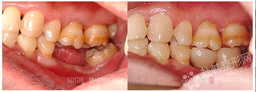 牙齿修复前后对比照