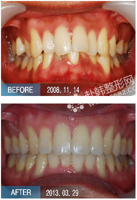 不齐牙齿矫正前后对比照