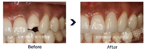 镶陶瓷牙对比照