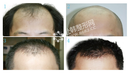 男性头发移植前后对比照