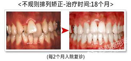 不规则牙齿矫正前后对比照-8682赴韩整形网