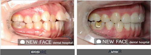 纽菲斯牙齿矫正,让牙齿畸形不再是疑难杂症