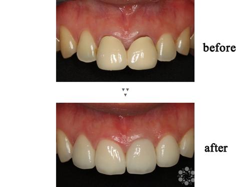 牙齿镶牙治疗前后对比