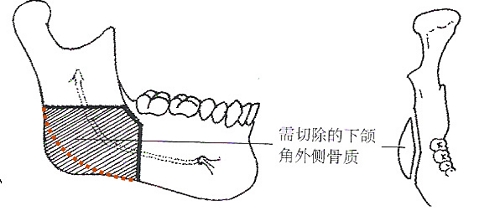 下颌角整形术演变过程组图