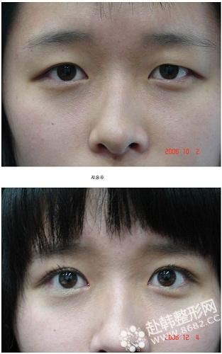 要想小眼睛变大就选韩国开眼角手术图