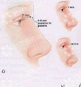 解读中国人的鼻部美学标准