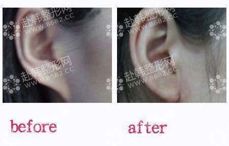 玻尿酸丰耳垂 让你的耳垂晶莹剔透，丰耳垂整形前后对比照