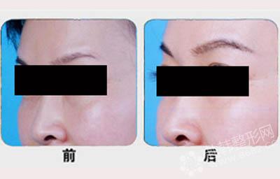 韩式植眉术可以改善哪些眉部缺陷?眉毛种植前后对比照