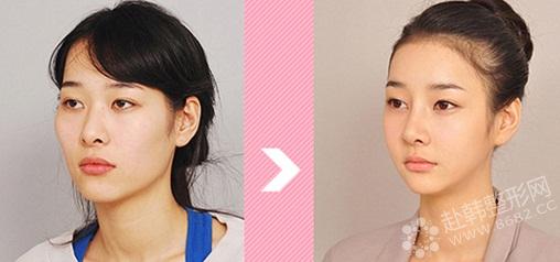 韩国童颜术术前术后效果对比图