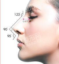 韩式隆鼻术具有哪些特点