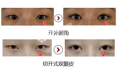 韩式开外眼角手术怎么做 开外眼角+切开式双眼皮前后对比