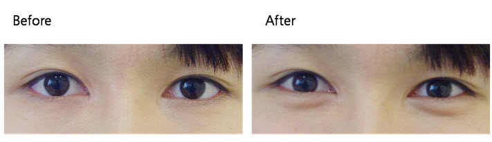 韩式娇媚术术前术后的注意事项|韩式娇媚术打造卧蚕眼整形前后对比图