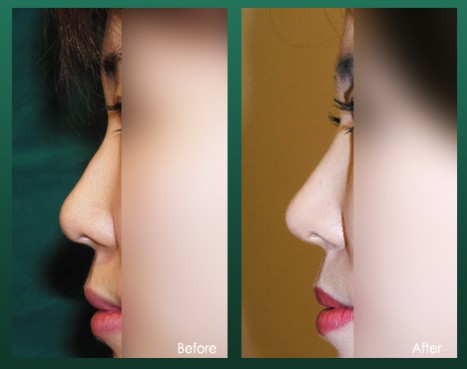 韩式隆鼻手术前后对比照