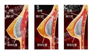 假体隆胸的切口方式和植入位置
