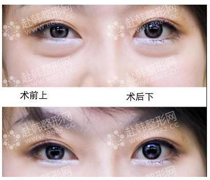 韩医介绍黑眼圈的治疗方案