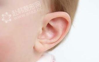 塑造耳型 招风耳术后护理不可忽视