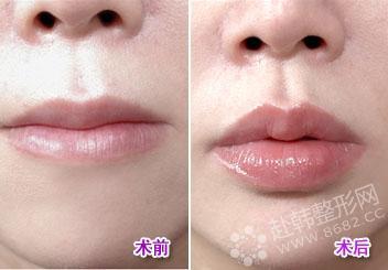 韩国专家介绍自体脂肪丰唇的优点