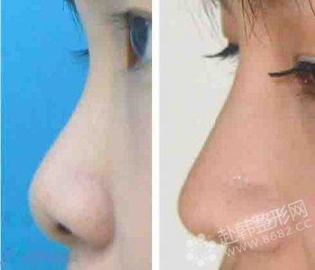 微晶瓷注射隆鼻有副作用吗