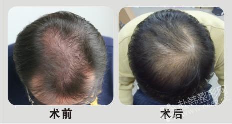 韩医解析毛发移植术的过程