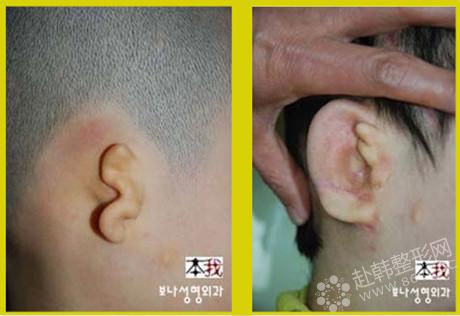小耳畸形修复前后对比照