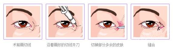 韩式开眼角手术步骤