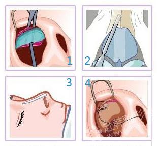 韩式隆鼻术手术图解