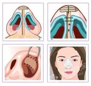 鼻尖整形手术图解