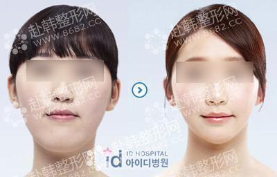 反颌矫正前后对比照 韩国ID整形医院