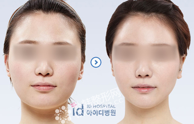 韩式下颌角手术对比照 韩国ID整形外科医院
