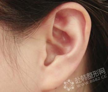 8682介绍耳部畸形再造术术后护理