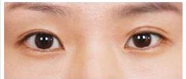 双眼皮变多眼皮 非切开式眼形矫正对比照