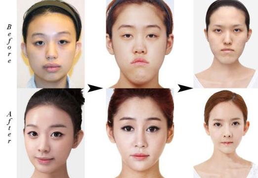 韩国丑女成功整容大变脸