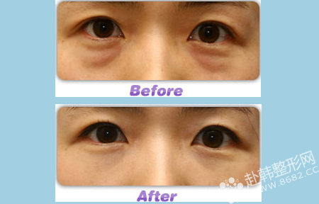 溶脂祛眼袋：的无痕祛眼袋方法 祛眼袋前后对比照片