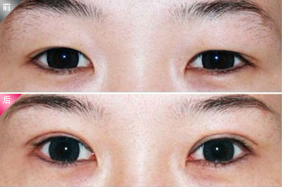 韩式双眼皮手术效果图