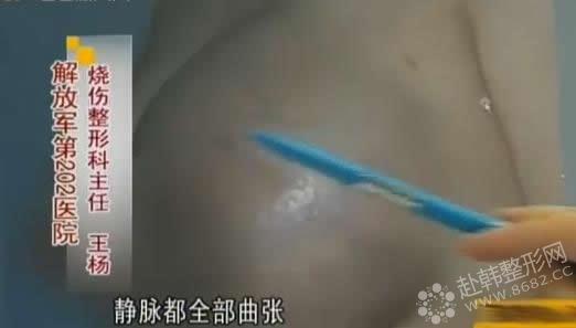 12年前注射丰胸 如今乳房变“石头”