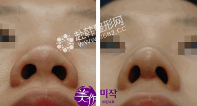 4大鼻头整形术“突”显你的美（图）