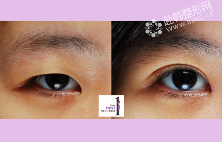 做双眼皮的3种方法 打造精致漂亮双眼
