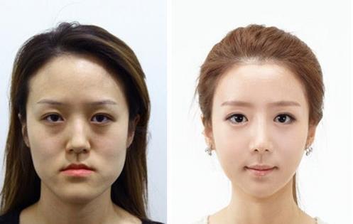 韩双胞胎整容数次变身女神