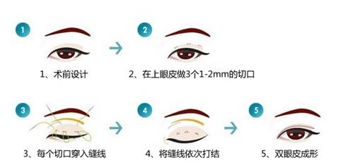 双眼皮手术是怎么做的？图解三种双眼皮整形术式