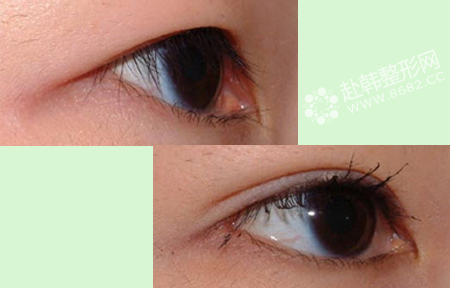 怎么使小眼睛变大 开外眼角手术前后对比照
