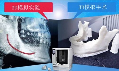 3D打印技术  让脸骨整形到位