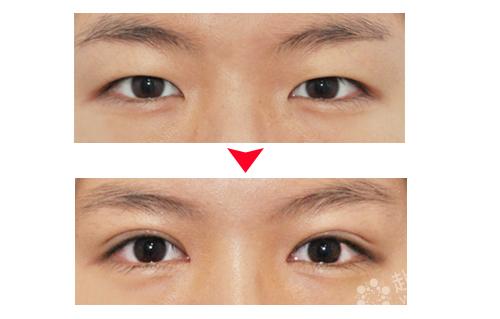 韩式无痕开眼的效果怎么样 埋线双眼皮+开眼角对比照