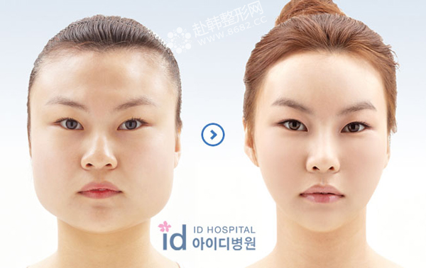 V-line四方脸整形前后对比照|方脸变小脸 韩国ID整容医院V-line四方脸整形